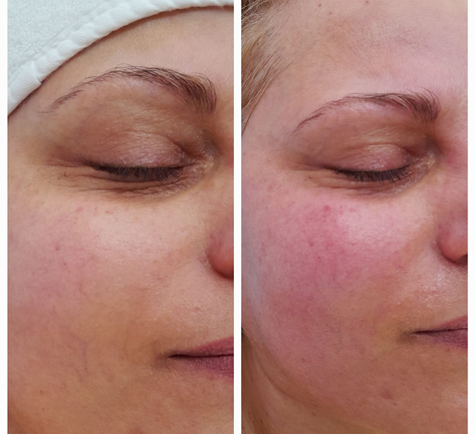 Beneficii oxygenera pro